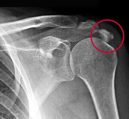 Les rayons X ont montré des dépôts de sels de calcium dans l'articulation