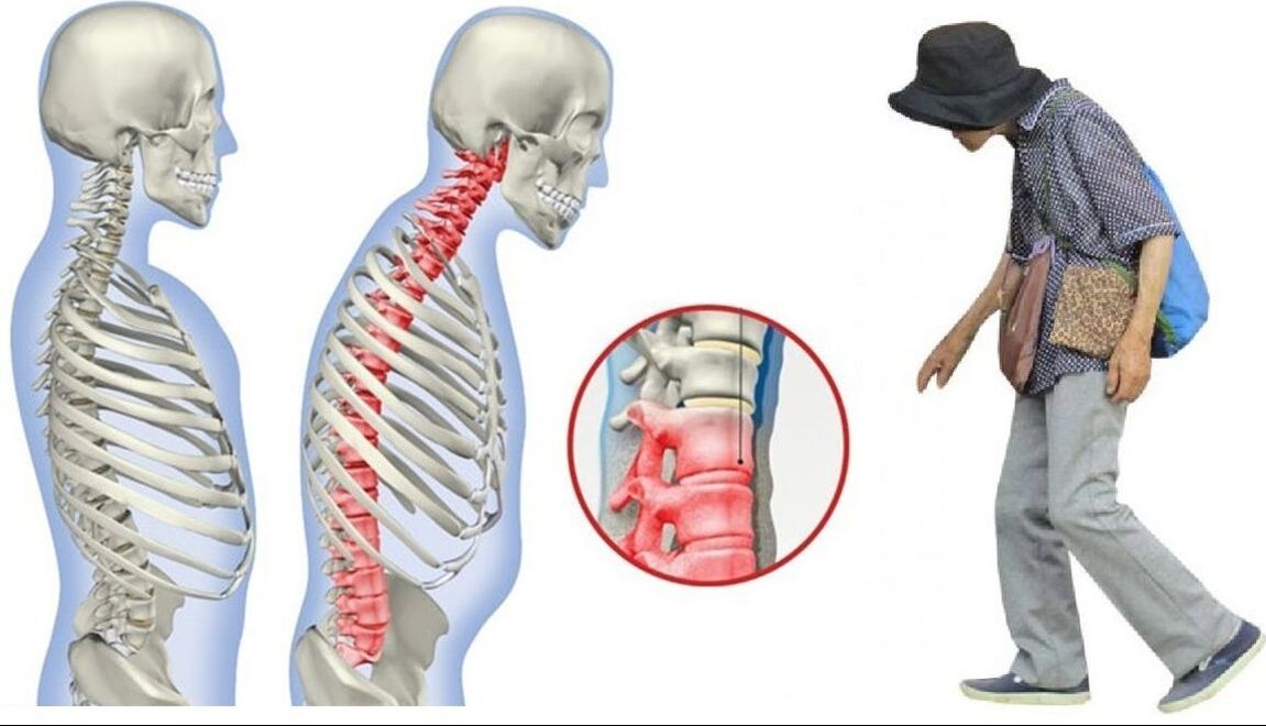 mal de dos dû à la spondylarthrite ankylosante