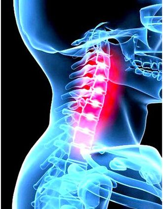 Image clinique de l'ostéochondose